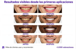 Tiras Blanqueadoras - SmileKit